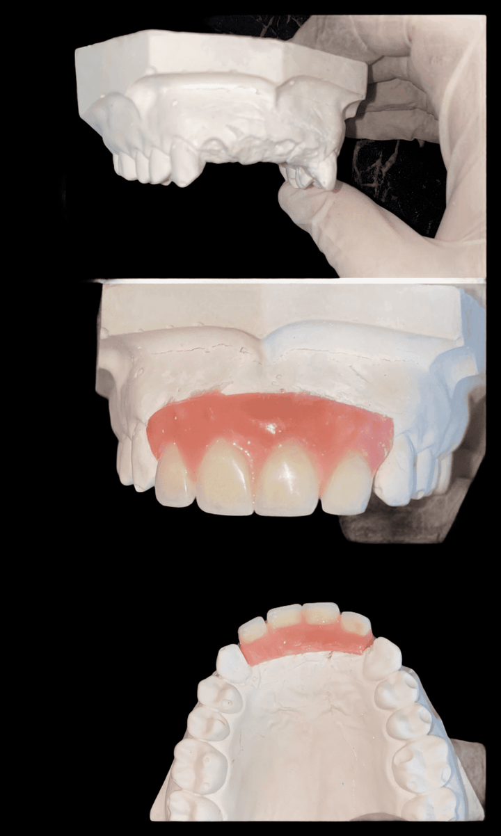 DIY Partial Denture Kit with Dental Impression Kit - DIY Denture Shop LLC ™