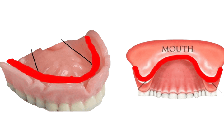 Secure Smile DIY Denture Reline Kit Gum Material - DIY Denture Shop LLC ™