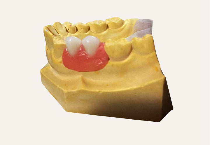 Tooth Replacement Kit with Alginate Impression Materials - DIY Denture Shop LLC ™